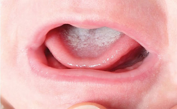 Bệnh tưa lưỡi hay gặp ở trẻ em là bệnh gì?